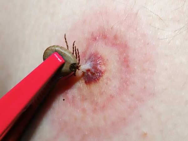 Черкаські фахівці пояснили, як не стати жертвою кліща та чому олія — ваш найгірший ворог