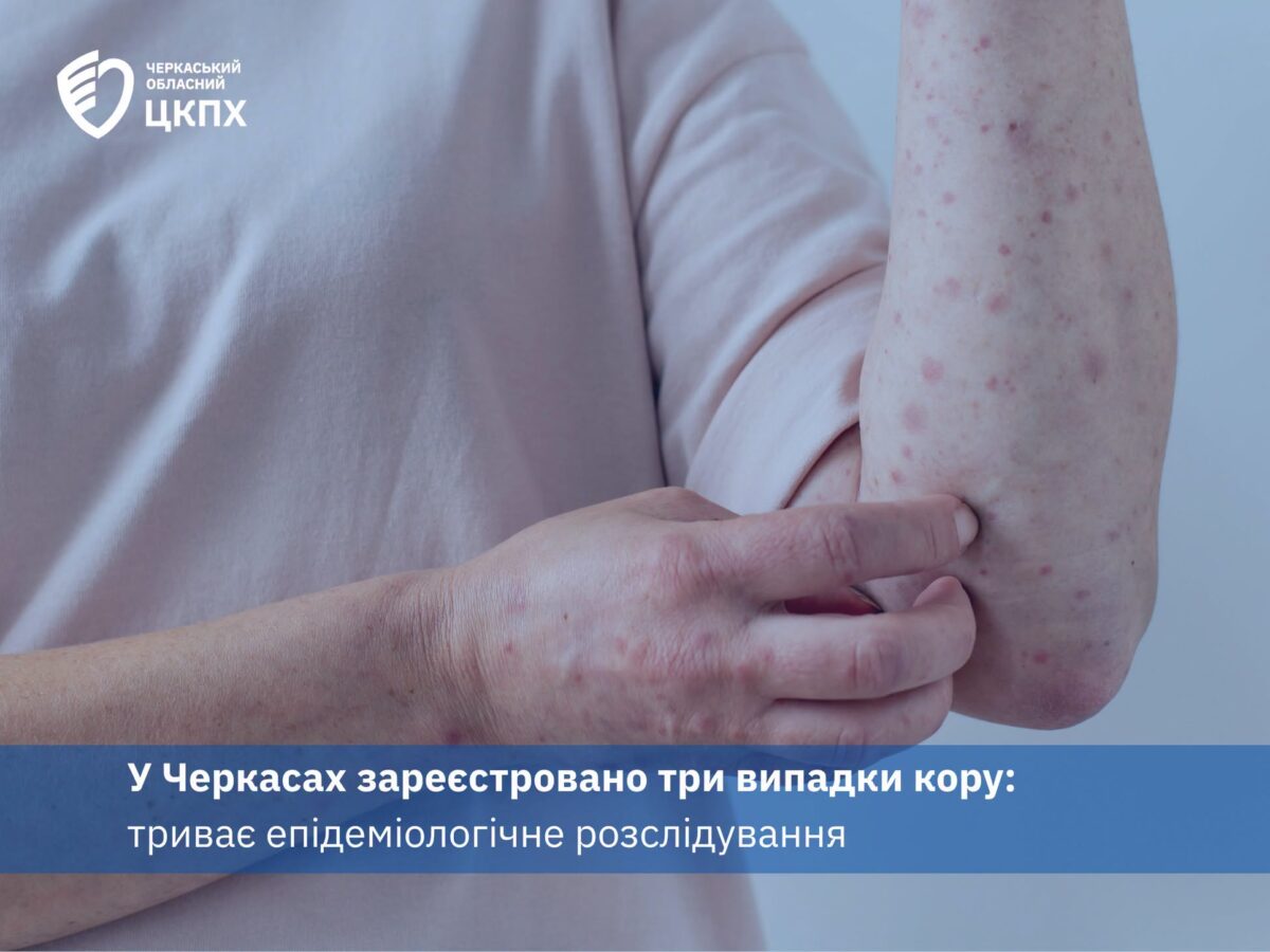 Кір у Черкасах: зареєстровано три випадки